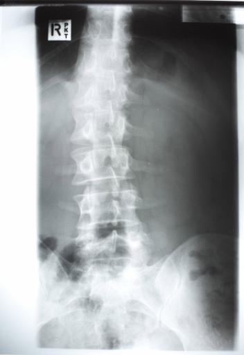 spine and pelvis x-ray