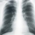 lung and chest x-ray